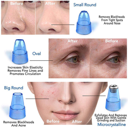 Blackhead Cosmetology Apparatus – Rechargeable Facial Suction Tool