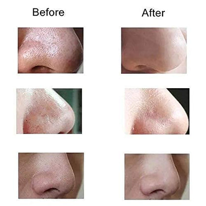 Blackhead Cosmetology Apparatus – Rechargeable Facial Suction Tool